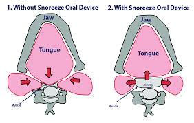 Oral Device - Muscle diagram