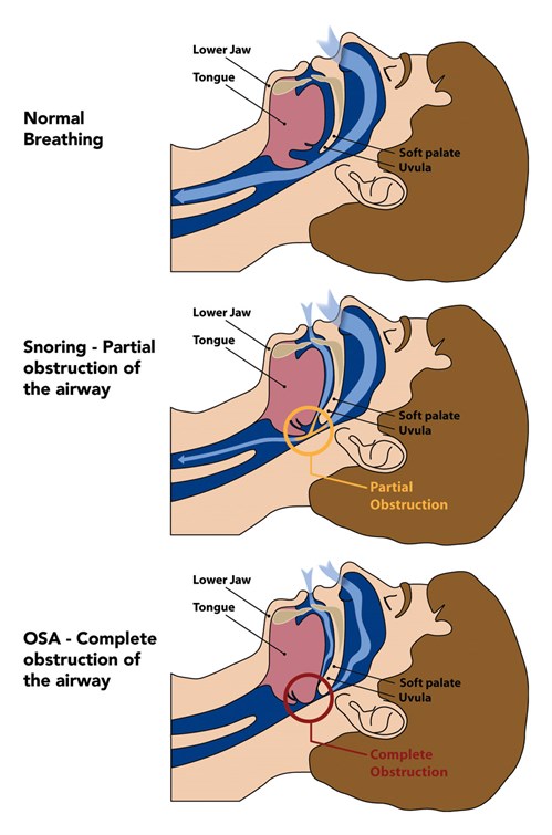 How an oral device treats snoring